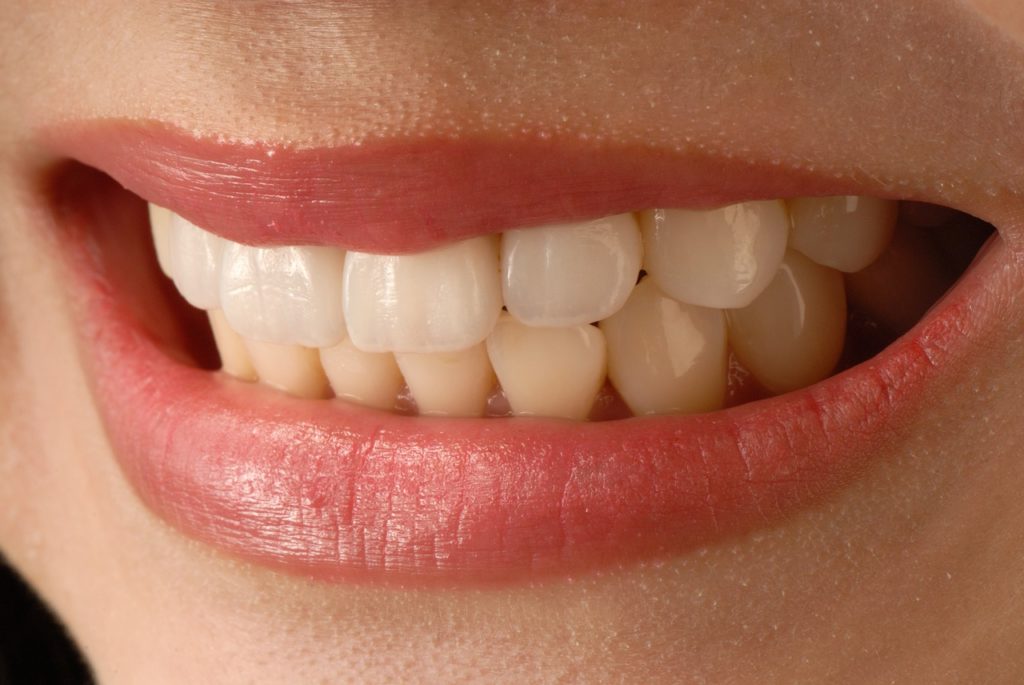 asian smile, anterior teeth, veneer-3672997.jpg