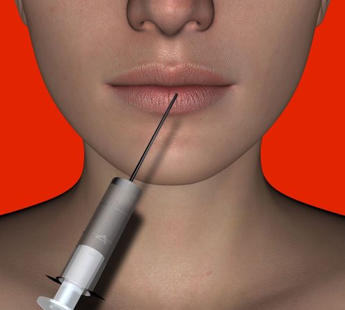 lips, injection, face-2122146.jpg